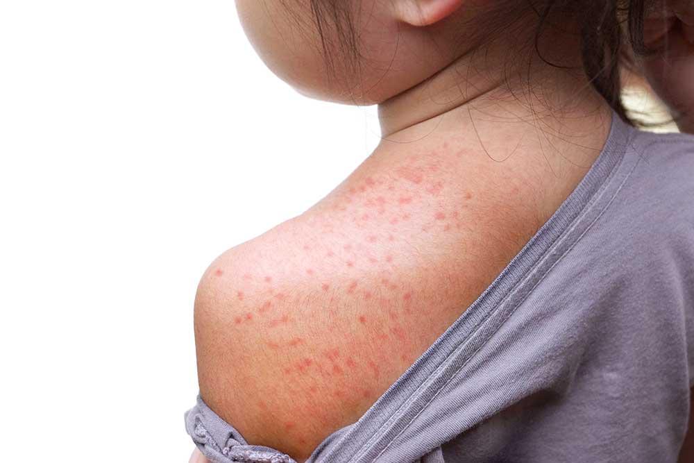 Measles Is Back in Texas—And It’s Worse Than You Think